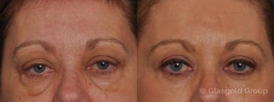 Upper Eyelid Before & After Gallery - Patient 158163 - Image 1