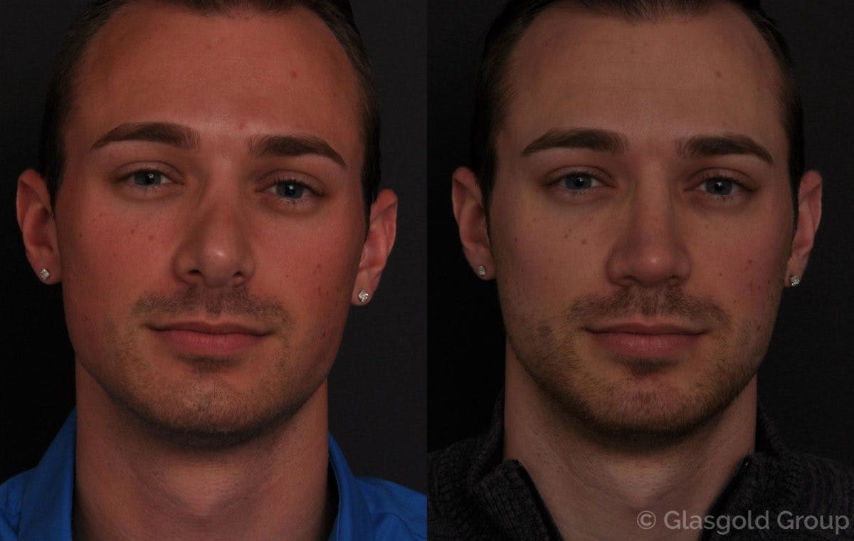 Revision Rhinoplasty Before & After Gallery - Patient 181429 - Image 2