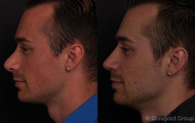 Revision Rhinoplasty Before & After Gallery - Patient 181429 - Image 1