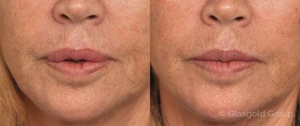 Lip Reduction Before & After Gallery - Patient 211299 - Image 2