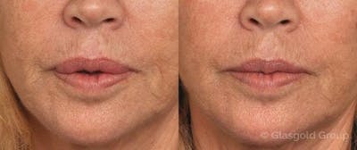 Lip Reduction Before & After Gallery - Patient 211299 - Image 1