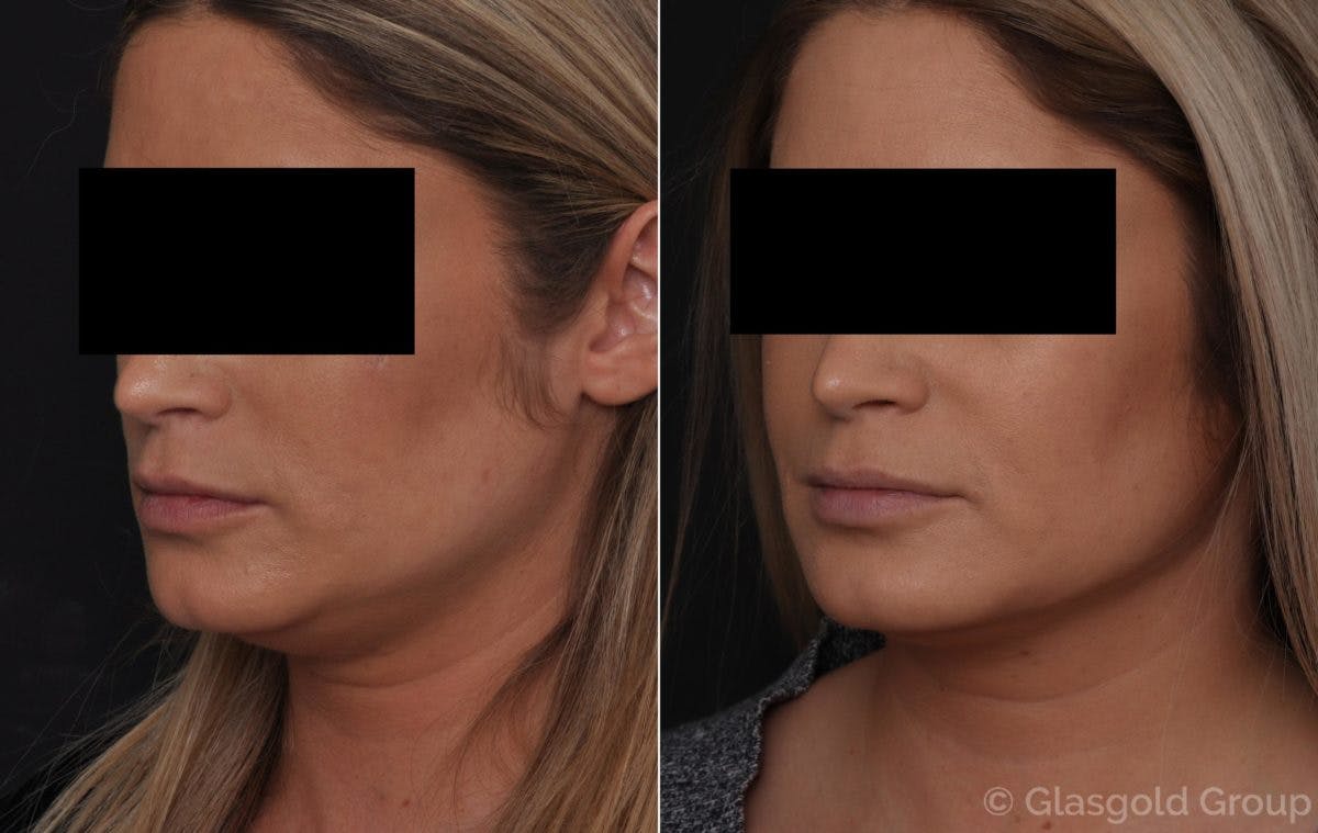 Neck Liposuction Before & After Gallery - Patient 112428 - Image 2
