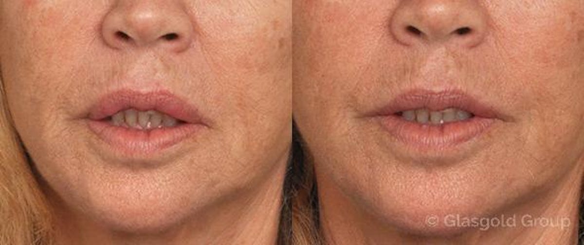 Lip Reduction Before & After Gallery - Patient 211299 - Image 3
