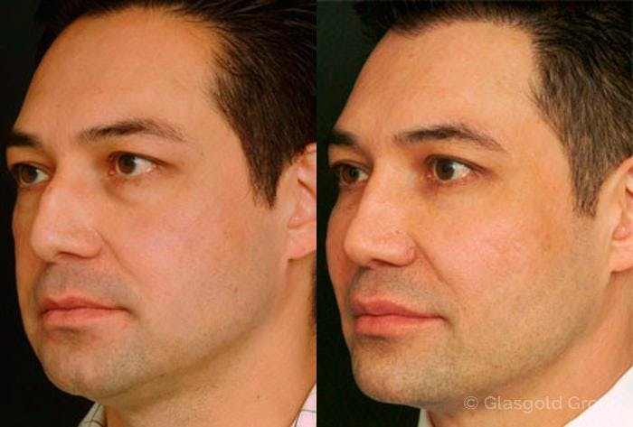 Lower Eyelid Before & After Gallery - Patient 169439 - Image 1