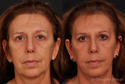 Upper Eyelid Before & After Gallery - Patient 252012 - Image 1