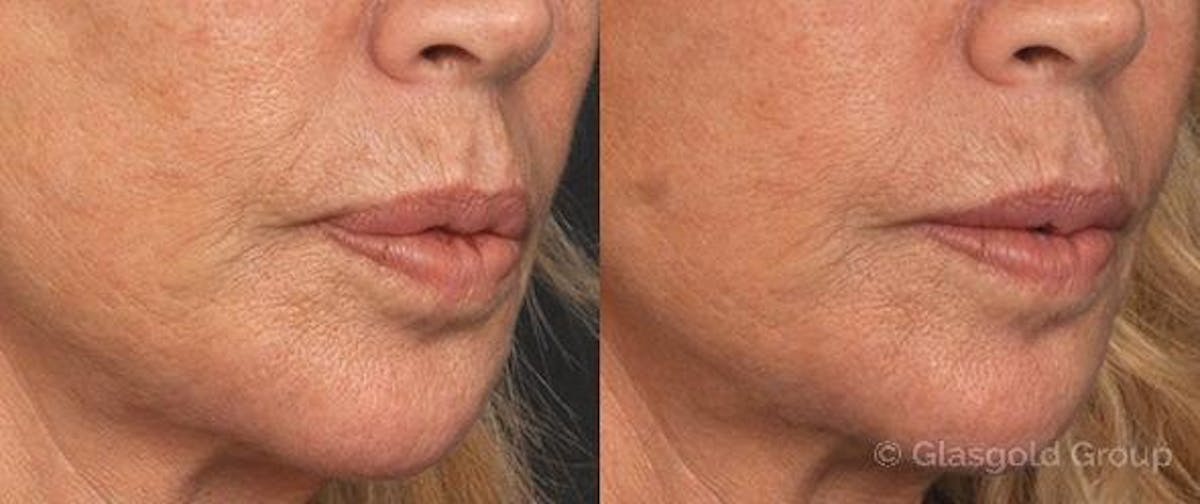 Lip Reduction Before & After Gallery - Patient 211299 - Image 1