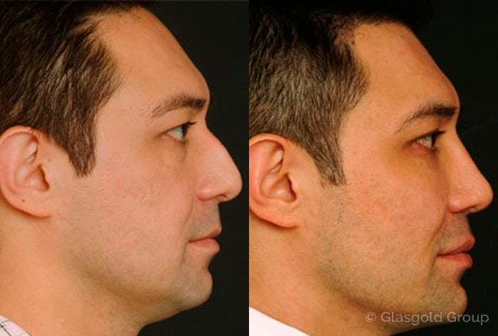 Lower Eyelid Before & After Gallery - Patient 169439 - Image 2