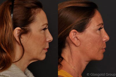 Facelift Before & After Gallery - Patient 158247 - Image 1