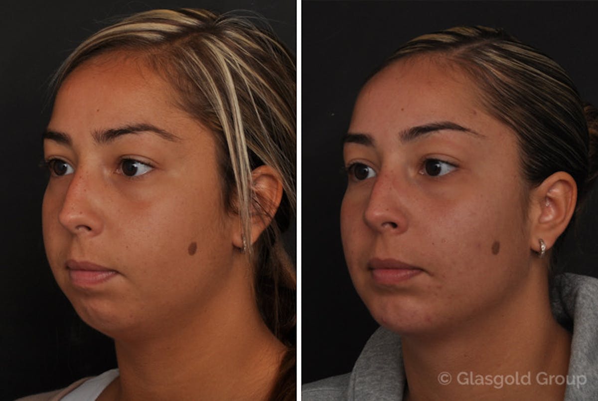 Chin Implants Before & After Gallery - Patient 510946 - Image 2
