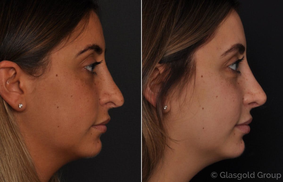 Revision Rhinoplasty Before & After Gallery - Patient 395812 - Image 1