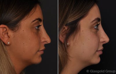 Revision Rhinoplasty Before & After Gallery - Patient 395812 - Image 1