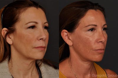 Facelift Before & After Gallery - Patient 158247 - Image 1