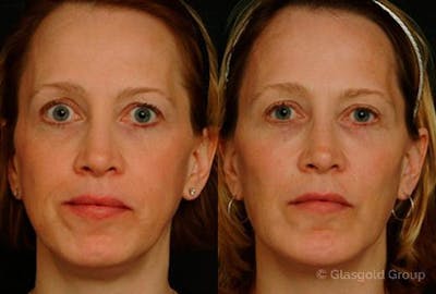 Upper Eyelid Before & After Gallery - Patient 284511 - Image 1