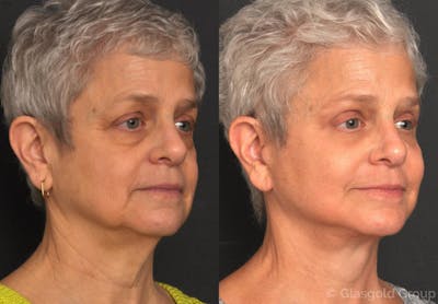 Lower Eyelid Before & After Gallery - Patient 378335 - Image 1
