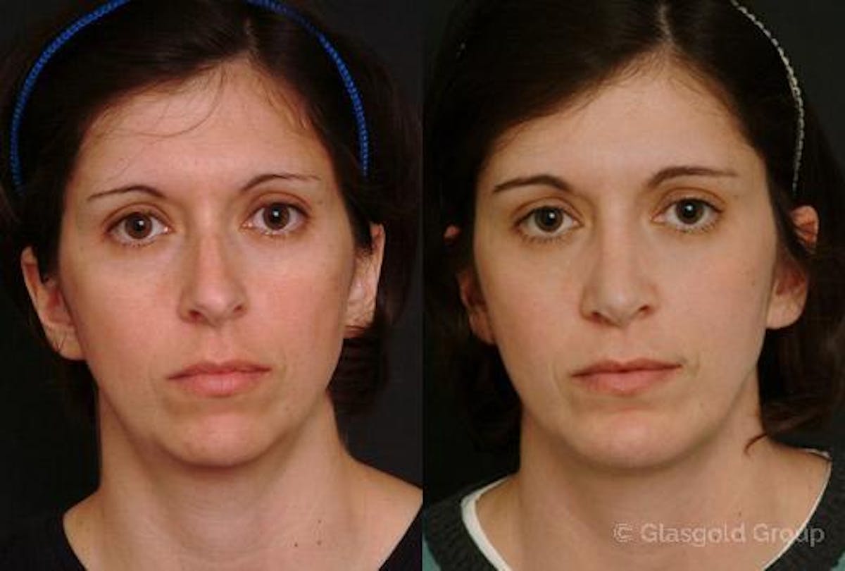Neck Liposuction Before & After Gallery - Patient 352147 - Image 1
