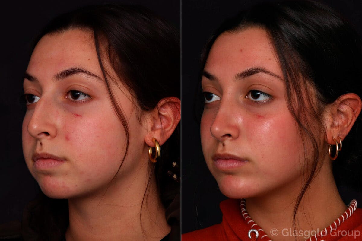 Rhinoplasty Before & After Gallery - Patient 334199 - Image 3