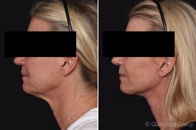 Facelift Before & After Gallery - Patient 433042 - Image 1