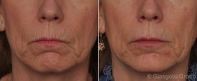 Lip Augmentation Before & After Gallery - Patient 340514 - Image 1