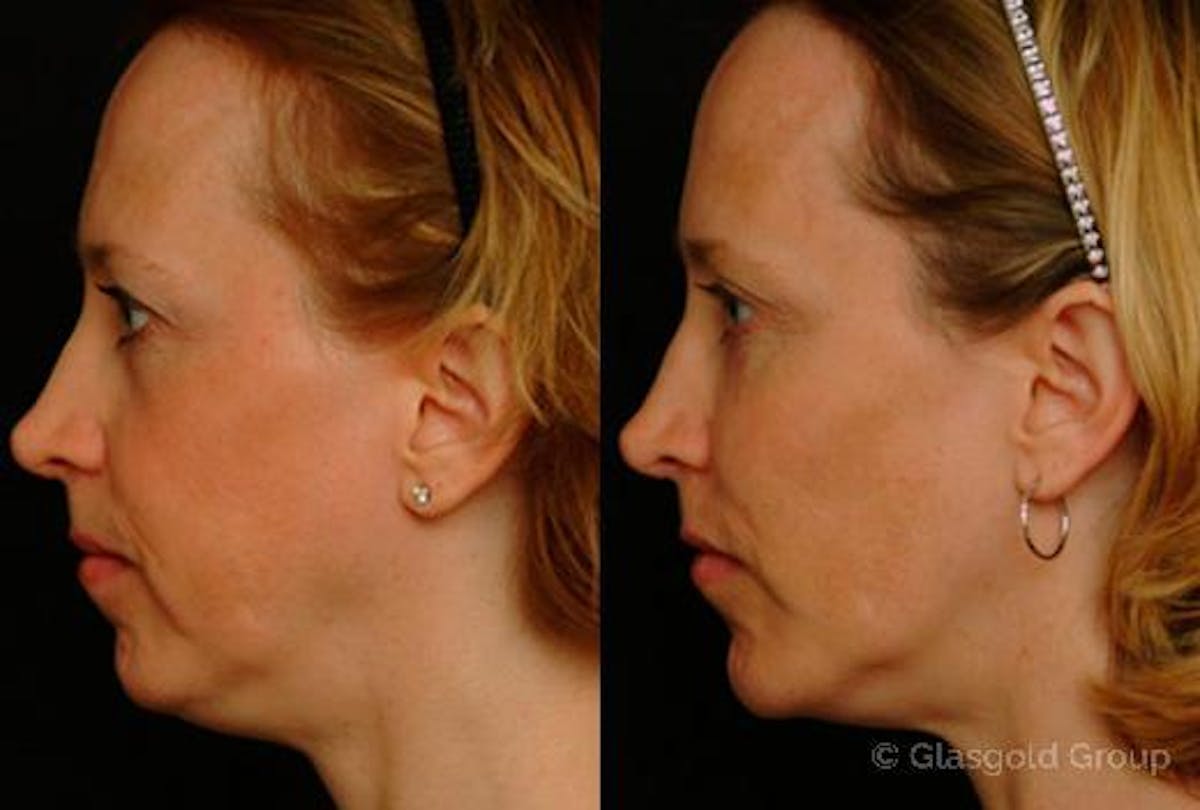 Upper Eyelid Before & After Gallery - Patient 284511 - Image 4