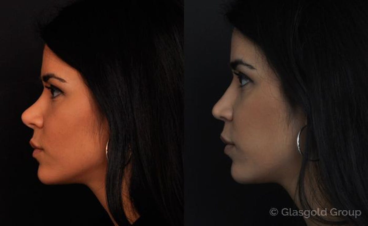 Revision Rhinoplasty Before & After Gallery - Patient 303127 - Image 1