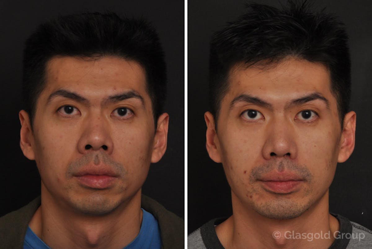 Chin Implants Before & After Gallery - Patient 329382 - Image 3
