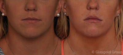 Lip Augmentation Before & After Gallery - Patient 404117 - Image 1
