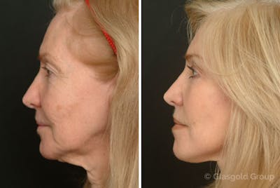 Facelift Before & After Gallery - Patient 719902 - Image 1