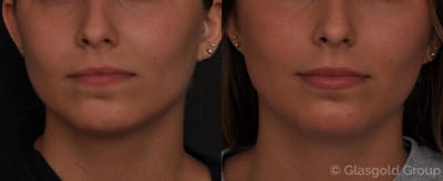 Lip Augmentation Before & After Gallery - Patient 128412 - Image 1