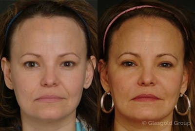 Upper Eyelid Before & After Gallery - Patient 755373 - Image 1