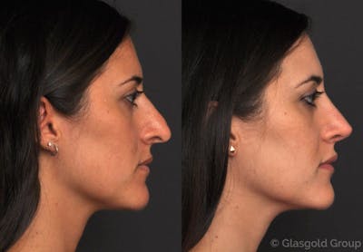 Revision Rhinoplasty Before & After Gallery - Patient 398973 - Image 1
