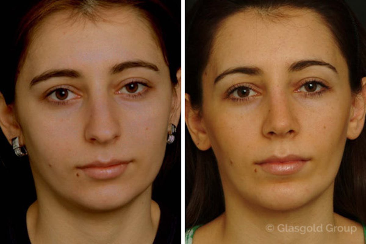 Chin Implants Before & After Gallery - Patient 301921 - Image 2
