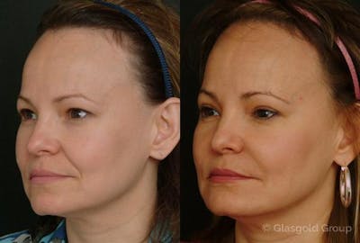 Upper Eyelid Before & After Gallery - Patient 755373 - Image 1