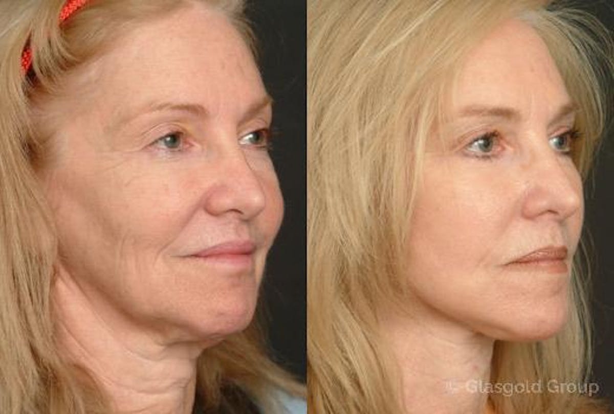 Facelift Before & After Gallery - Patient 719902 - Image 1