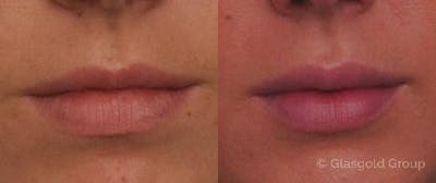 Lip Augmentation Before & After Gallery - Patient 391519 - Image 1