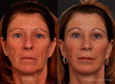 Upper Eyelid Before & After Gallery - Patient 244389 - Image 1