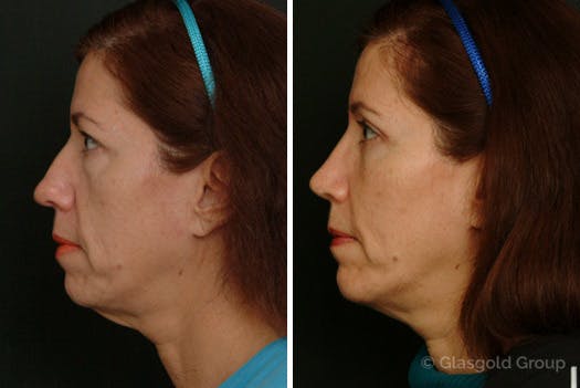 Chin Implants Before & After Gallery - Patient 353756 - Image 1