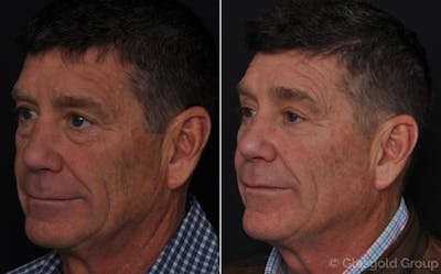 Lower Eyelid Before & After Gallery - Patient 217936 - Image 1
