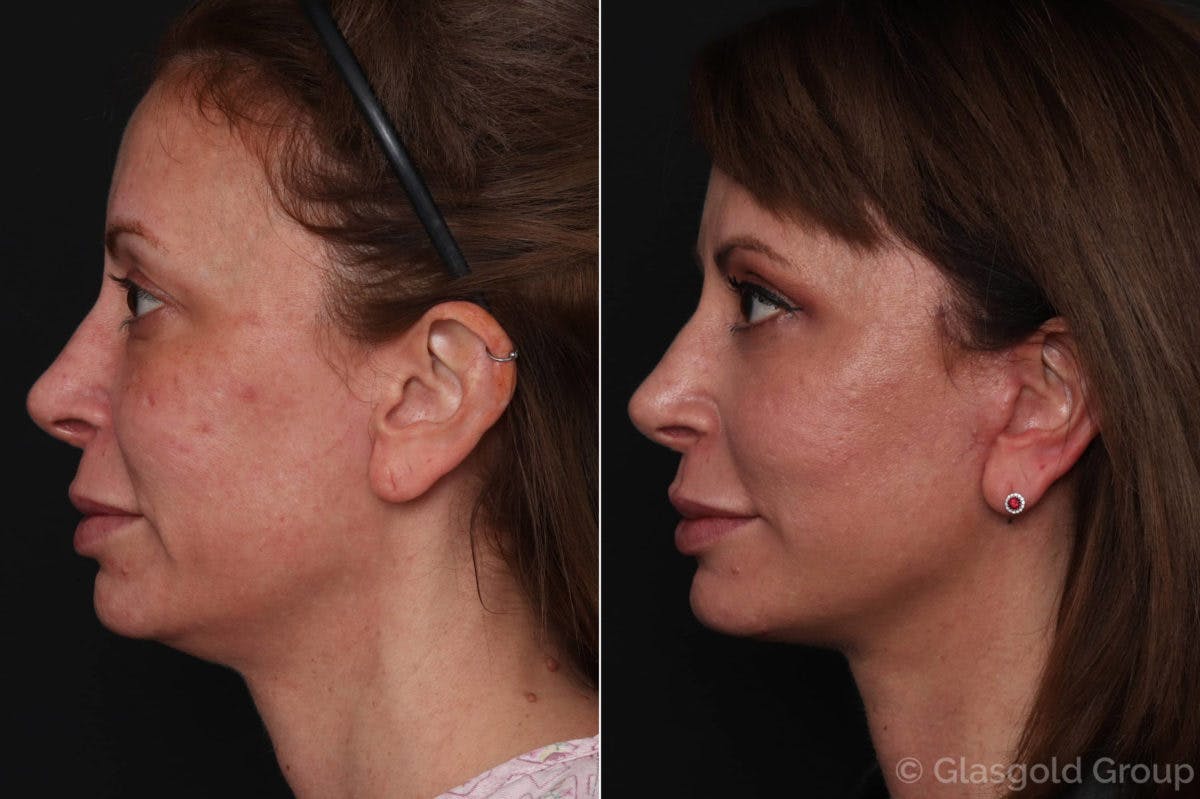 Facelift Before & After Gallery - Patient 100527 - Image 2