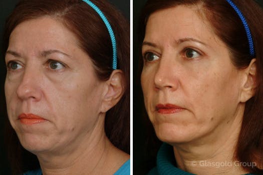 Chin Implants Before & After Gallery - Patient 353756 - Image 2
