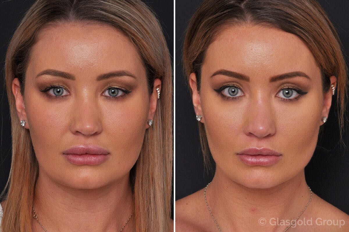 Buccal Fat Removal Before & After Gallery - Patient 143175 - Image 2