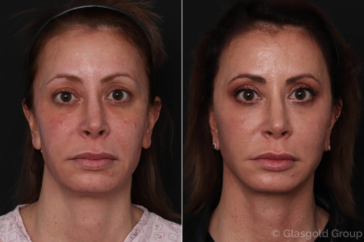 Facelift Before & After Gallery - Patient 100527 - Image 3