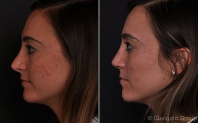 Revision Rhinoplasty Before & After Gallery - Patient 308262 - Image 1