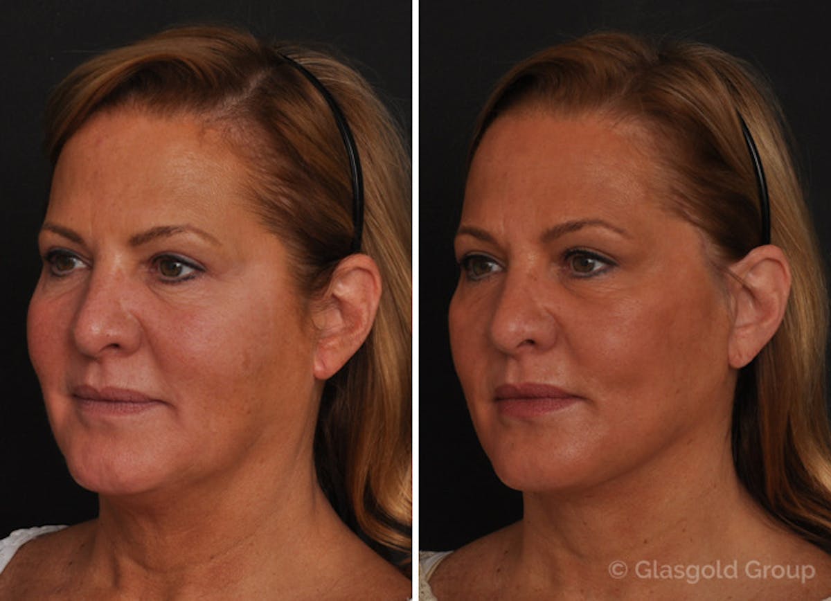 Lower Eyelid Before & After Gallery - Patient 265307 - Image 1