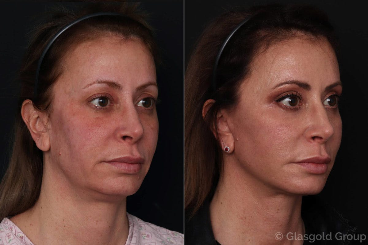Facelift Before & After Gallery - Patient 100527 - Image 1