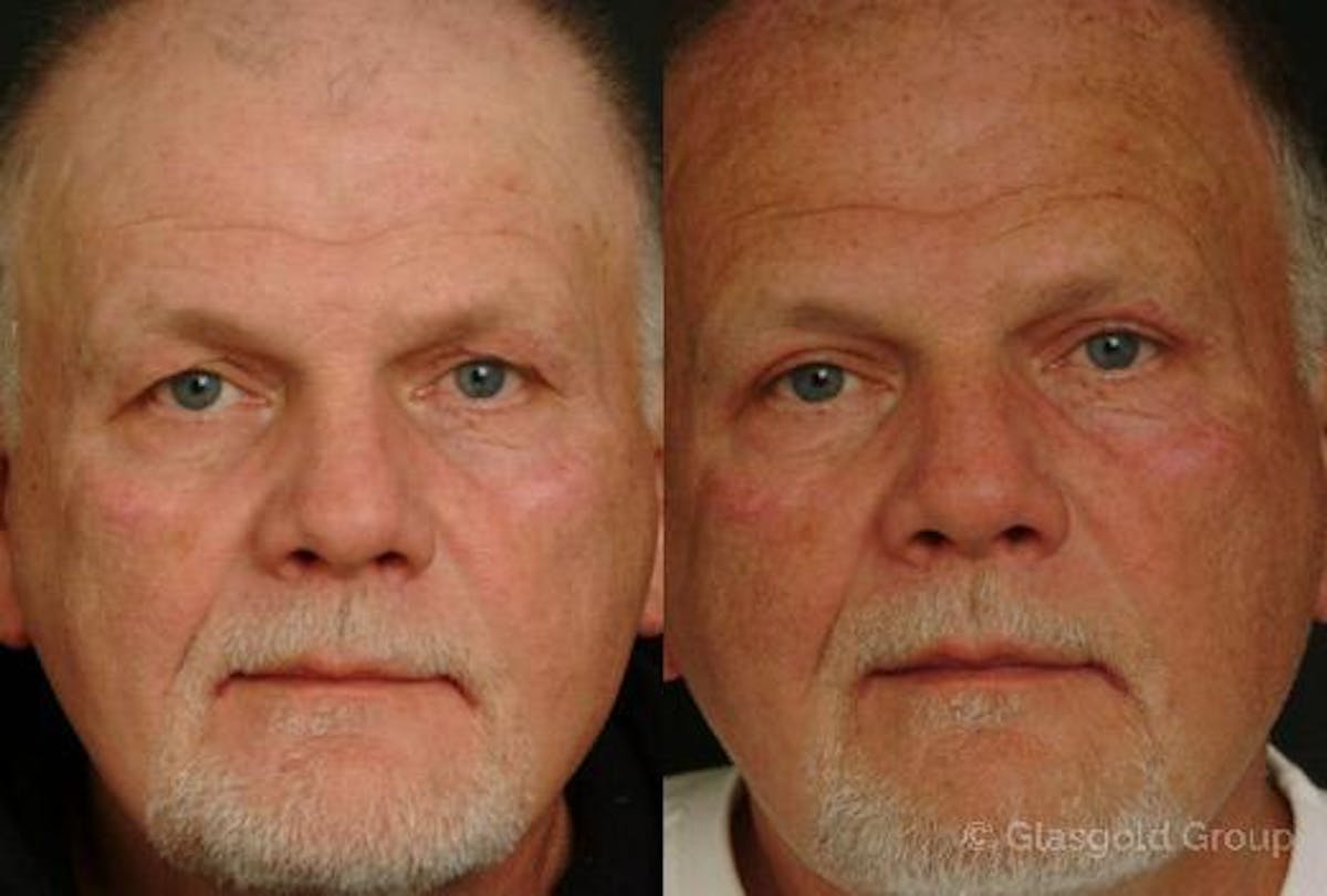 Upper Eyelid Before & After Gallery - Patient 200492 - Image 2