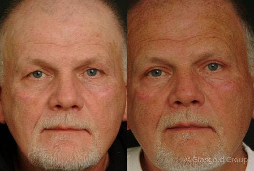 Upper Eyelid Before & After Gallery - Patient 200492 - Image 2