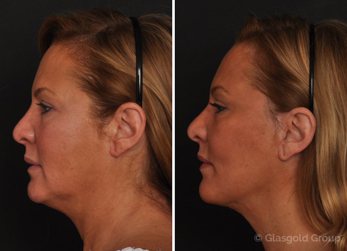 Lower Eyelid Before & After Gallery - Patient 265307 - Image 2