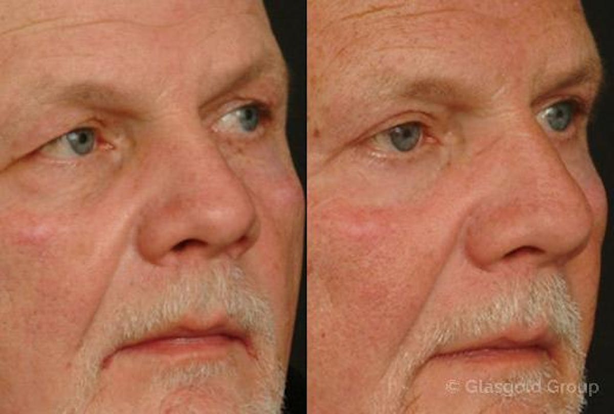 Upper Eyelid Before & After Gallery - Patient 200492 - Image 1