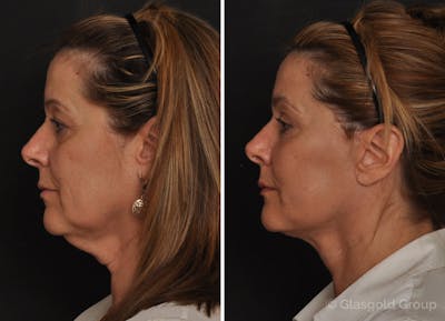 Facelift Before & After Gallery - Patient 115864 - Image 1