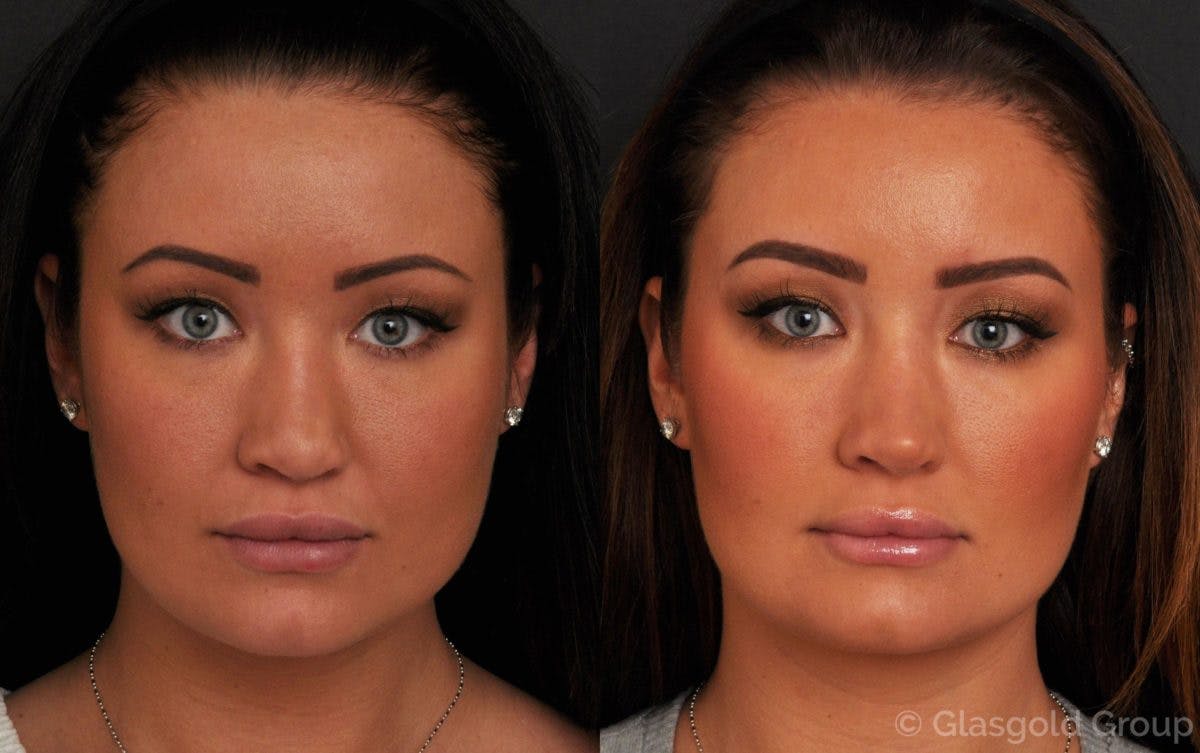 Revision Rhinoplasty Before & After Gallery - Patient 466199 - Image 2